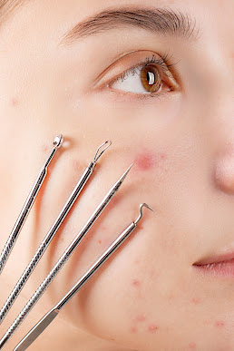 teen skin problem 